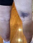 Click image for larger version. 

Name:	Bruise.jpg 
Views:	213 
Size:	88.1 KB 
ID:	15002